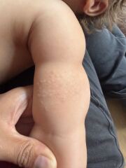 Bumps on upper arm