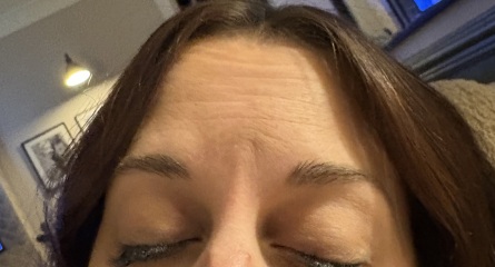 First time Botox for upper face - any experiences or advice?
