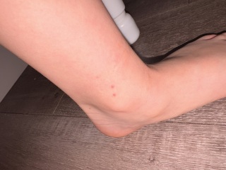 Could this be a second, milder case of chickenpox in my son?