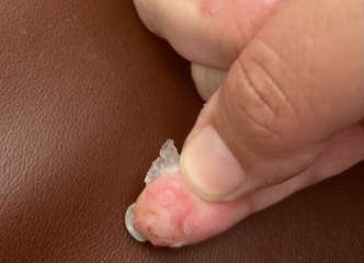 Peeling finger after pompholyx eczema flare