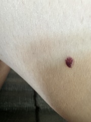 Darkened raised skin mark changing colour over the past year