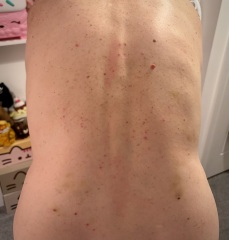 Rash for 3 months - please help!