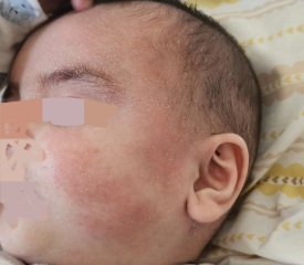 Advice on recurring rash and possible eczema or allergies in a baby