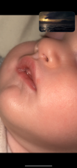 Herpe or spot newborn