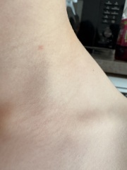 Could this be a second, milder case of chickenpox in my son?