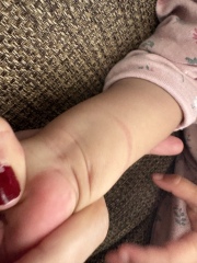 What could cause this mark on my daughter’s wrist?
