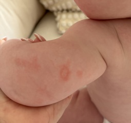 Thoughts on what this could be on 6mo son and should I get it looked at today?