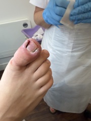 Partial toenail avulsion with phenol