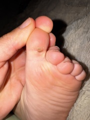 Hard sensitive spot under my two year old’s toe