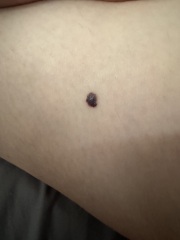 Darkened raised skin mark changing colour over the past year