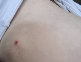 To not go to GP for breast lump?  Think it is infected - photos