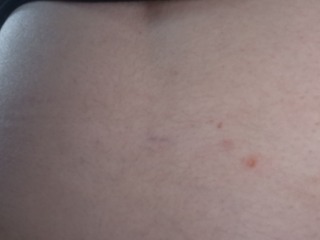 Red spot on back persistant scab please help
