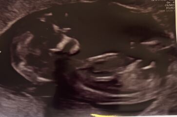 Nub theory guesses from 13 week scan?!