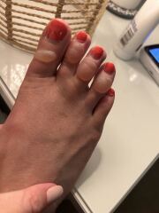 Big blisters all over feet