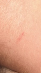 What would cause a bite like this?