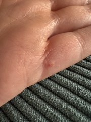 Is this most likely scabies?