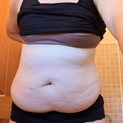 Will my apron belly improve with further weight loss and exercise