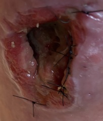 Chronic wound after dog attack, 6 months later