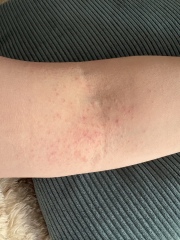 Is this most likely scabies?