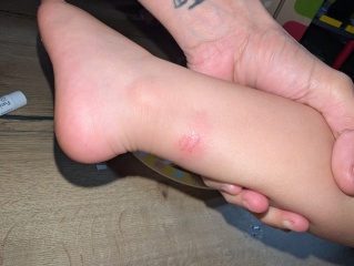 Advice after allergic reaction to insect bites in my two-year-old