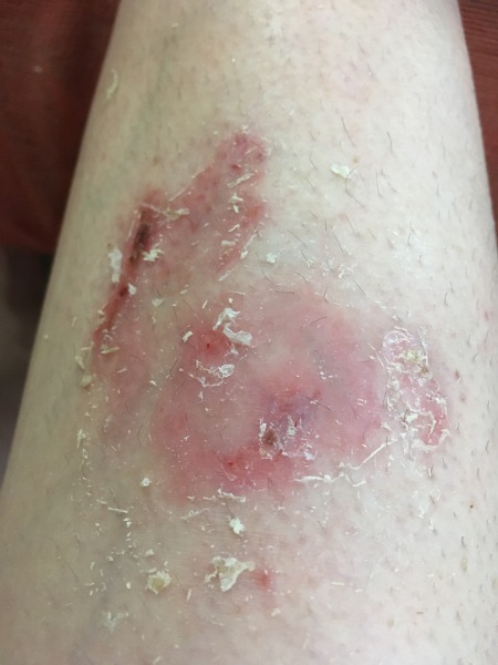 Has anyone had an insect bite go like this?