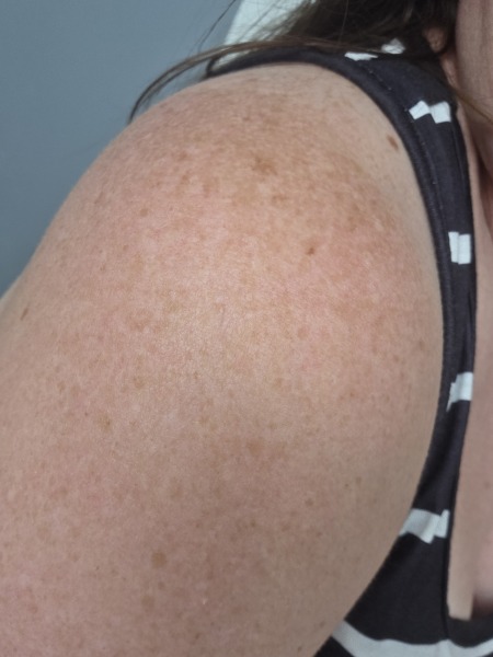 Does this look like melanoma?