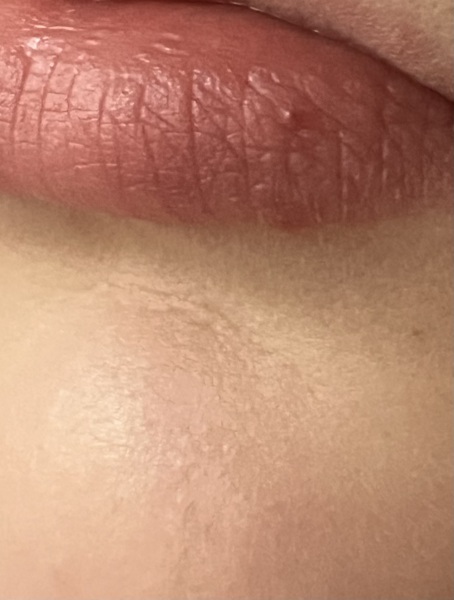 Is this a cold sore?