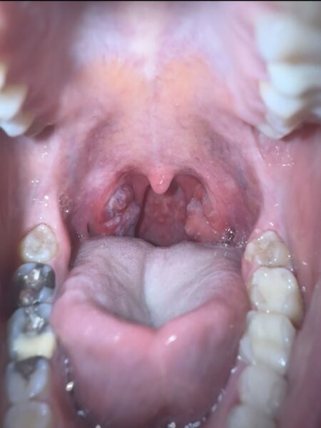 Tonsilitis
