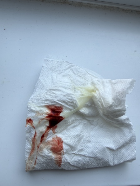 Bleeding whilst on aspirin