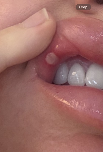 Painful mouth ulcer not improving, any suggestions for relief?