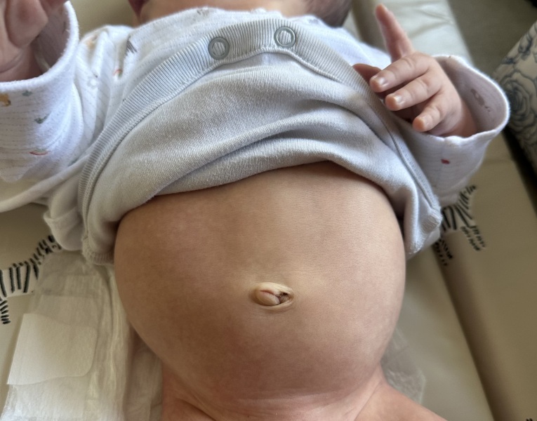 Three week old with unusual stomach shape