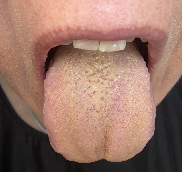 Coated tongue despite good oral hygiene, any ideas or tips?