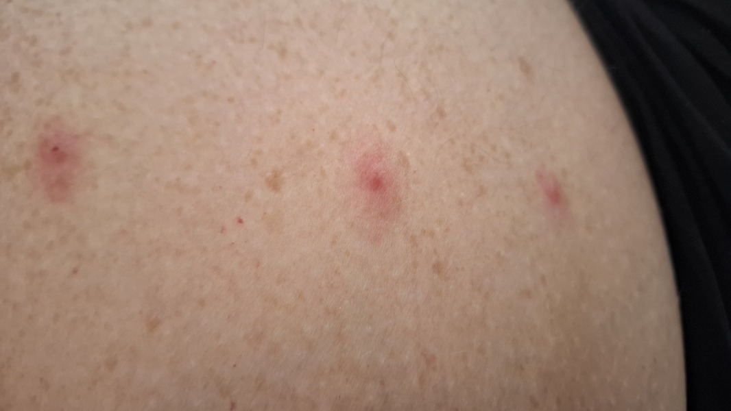 Are these bedbug bites?