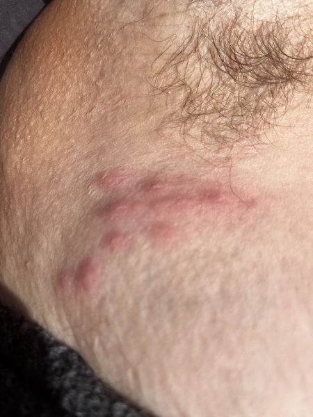 Possible shingles ? Pic attached cluster of 12 red spots