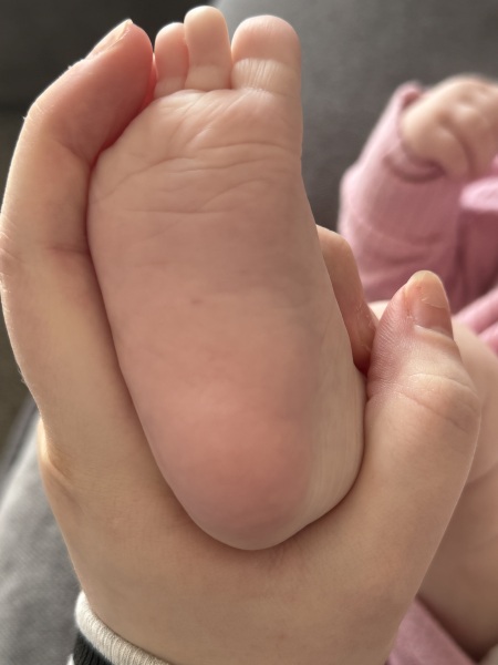 Baby rash on feet