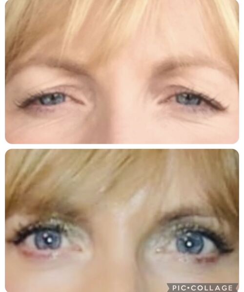 Upper blepharoplasty