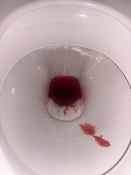 Bleeding both ends