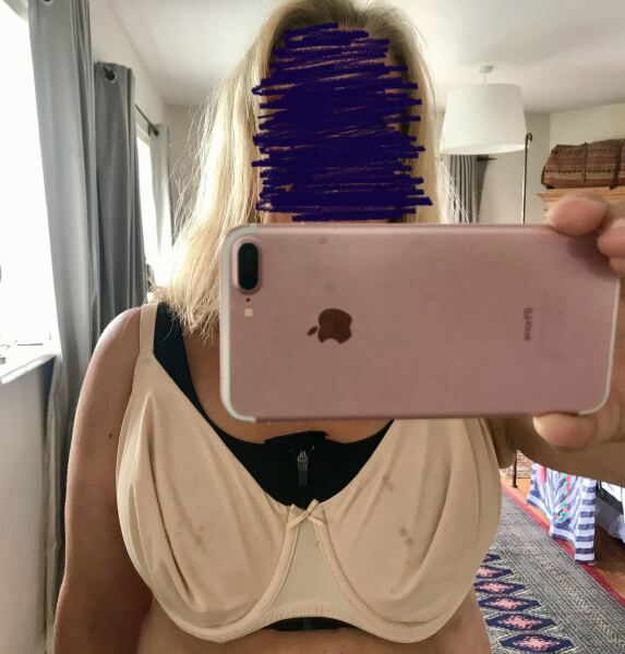 Breast reductions thread 4