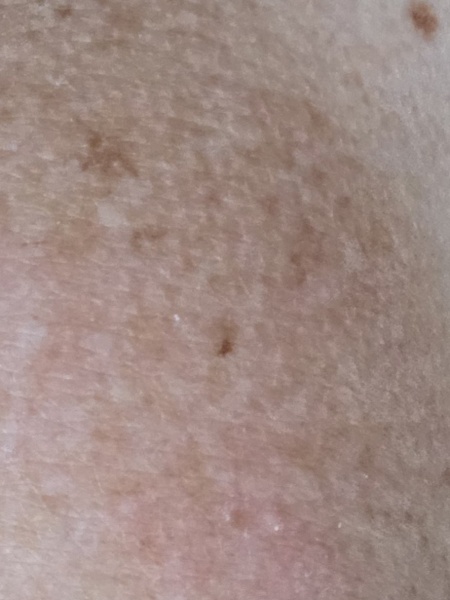 Does this look like melanoma?
