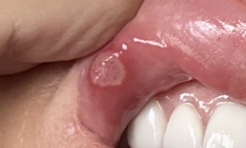 Painful mouth ulcer not improving, any suggestions for relief?
