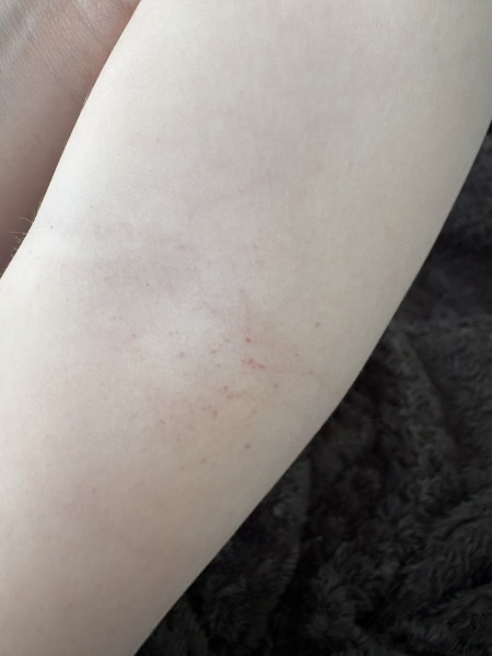 How common is petechiae with a viral infection in children?