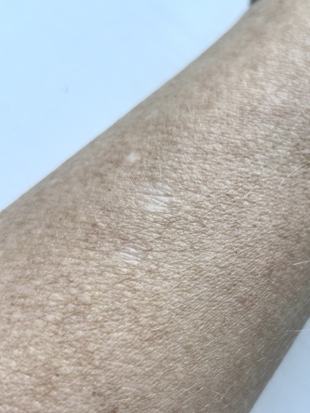 Does anyone know what these white marks on my arms are?