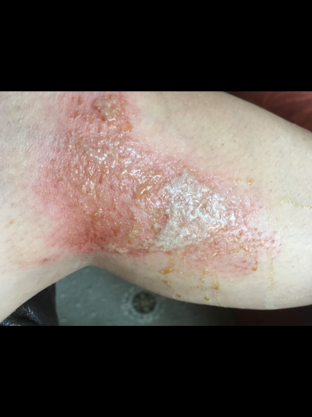 Has anyone had an insect bite go like this?