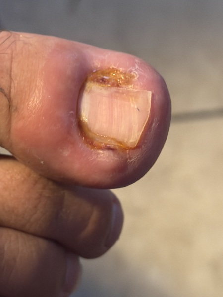 Partial toenail avulsion with phenol