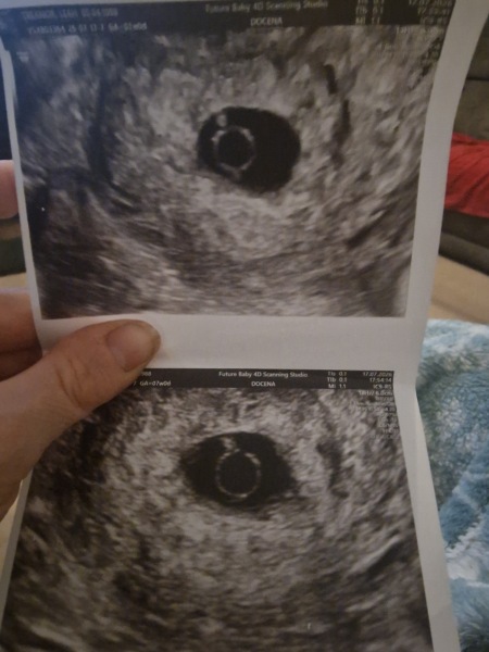 Seven-week scan measuring behind with no heartbeat, any positive outcomes?