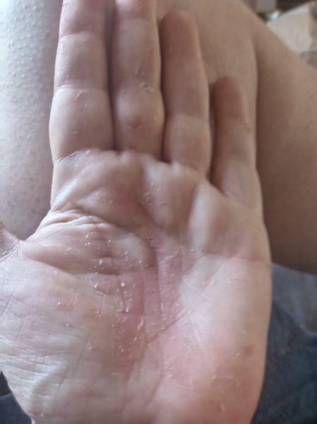 Is eczema always itchy? Cracked finger tips
