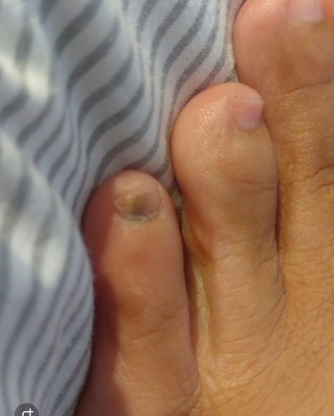 Sublungual melanoma fears - brown mark under toenail while on holiday and feeling anxious
