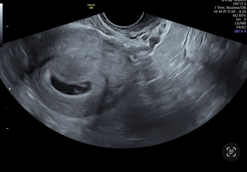 Six week scan showing yolk sac but no clear fetal pole
