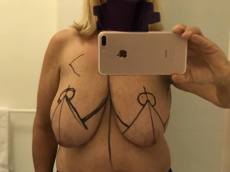 Breast reductions thread 4