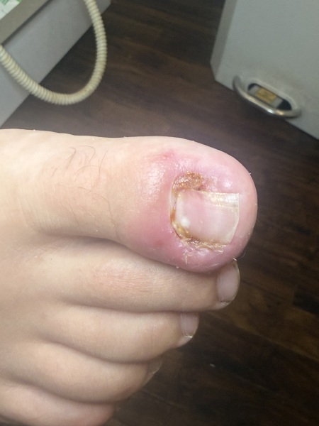 Partial toenail avulsion with phenol